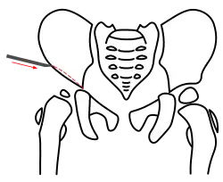 Acetabuloplastik, Schritt 1, Osteotomie des Darmbeins