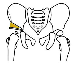 Acetabuloplastik, Schritt 4, ggf. Osteosynthese mit einem Kirschner-Draht