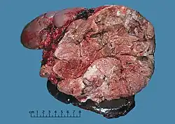 Ein Bild von einem entfernten Nebennierenrindenkarzinom. Die Schnittfläche ist sehr ungleichmäßig mit ungleichmäßigem und mehrfahrbigem Wachstum.