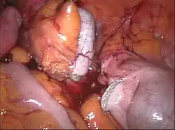 Appendix vermiformis nach der Abtrennung mit dem Stapler