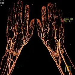 CT-Angiographie der Hände