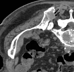 Vor der RFA: Hinterer oberer Darmbeindorn (Spina iliaca posterior superior) mit osteolytischer Metastase (ca. 2&nbsp;cm im Durchmesser, siehe Pfeile)