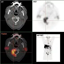 Osteolytische Knochenmetastase im zweiten Halswirbelknochen (Axis) eines metastasierten Prostatakarzinoms