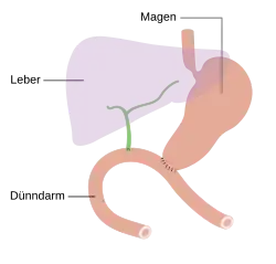 Endzustand nach Totalresektion