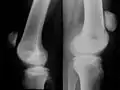 Differentialdiagnose Riss der Patellarsehne: Zeichen im Röntgenbild: Hochstand der Patella.