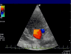 Anwendung des Doppler-Verfahrens bei einer Herzuntersuchung: Mitralklappeninsuffizienz