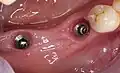 Eingeheilte Implantate vor Einsetzen einer Implantatbrücke