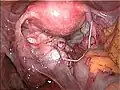Massive Verwachsungen bei Endometriose