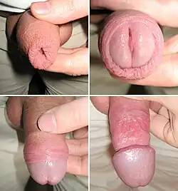 Männliche Vorhaut beim Zurückziehen