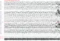 Generalisierter Spike-Wave-Komplex über 20 Sekunden