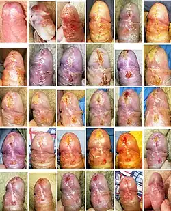 Zustand vor Frenulotomie (Bild 1; 2) und Heilungsverlauf nach chirurgischem Eingriff