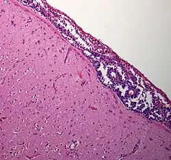 Hirnbiopsie: Nachweis einer Ausbreitung leptomeningealer Tumorzellverbände in einer Hirnbiopsie. Hämatoxylin-Eosin-Färbung.