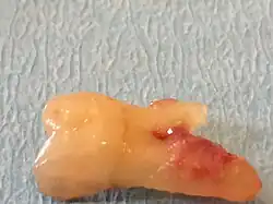 Entferntes bukkales Zahnfragment eines Molaren (Zahn 16) nach einer Längsfraktur