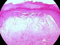 Lichen sclerosus (hypertrophische Form)