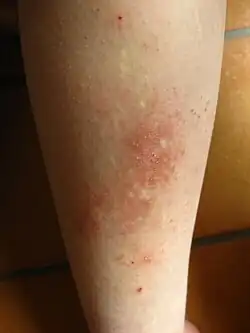 Rezidiv eines Lichen simplex chronicus am Schienbein