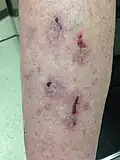 Lichen planus über dem Schienbein, hier mit Ulzerationen