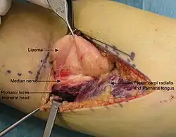 Das Lipom in der Armbeuge (oben), während der Operation zu seiner Exzision.[15]