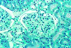 Diese lichtmikroskopische Aufnahme zeigt die Akkumulation von Gb3 in den Endothelien des Glomerulums, in den Mesangiumzellen, den Zellen im Interstitium und in den Podozyten.