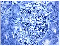 Ebenfalls eine lichtmikroskopische Aufnahme. In den Podozyten ist die erhöhte Ansammlung an Gb3 durch eine violette Anfärbung sichtbar gemacht worden.