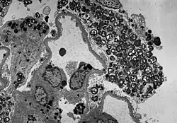Die TEM-Aufnahme zeigt die massive elektronendichte (= schwarze) Ansammlung an Glycosphingolipiden im Lysosom der Podozyten.