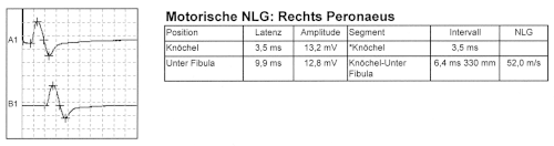 Normale motorische Neurografie am N. peronaeus