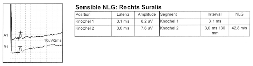 Normale sensible Neurographie am N. suralis