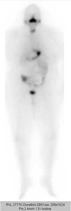 …nach 3. ablativer Radiojodtherapie mit 3,7 GBq Jod-131. Minimale Speicherung in der Restschilddrüse.