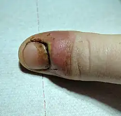 Nagelbettentzündung. Starke Rötung rund um den hinteren Bereich des Daumennagels. Deutliche Schwellung durch eine Eiteransammlung unter der Haut.