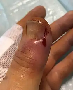 Inzision und Teilentfernung des Daumennagels nach Paronychie