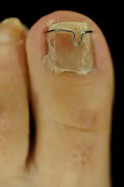 Konservative Behandlung bei Unguis incarnatus mittels Nagelspange