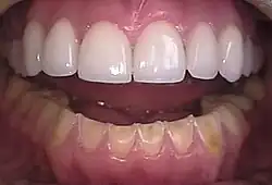 Gebiss, das von Usur betroffen ist. Die Schneidekanten verschwinden allmählich, die Zähne werden kleiner aber nicht schmaler.