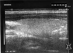 Zum Vergleich: normale Echogenität der Schilddrüse
