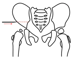 Salter-Osteotomie rechts. Schritt 1 – Osteotomie des Os ilium