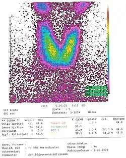 Szintigraphie einer Schilddrüse mit Uptake und Größe im oberen Normbereich. Oberhalb der SD sind die Unter­kiefer­speichel­drüsen zu erkennen.