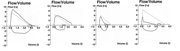 Typische Fluss-Volumen-Diagramme bei (v. l. n. r.) normaler Atmung, fehlender Mitarbeit des Patienten, Asthma, und COPD