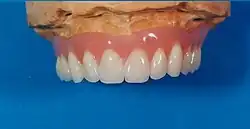 Frontansicht des Zahnersatzes