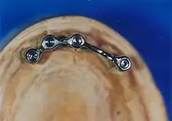 Festsitzender Teil der Unterkiefer-Hybridprothese von okklusal gesehen