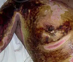 Verbrennung 3.&nbsp;Grades