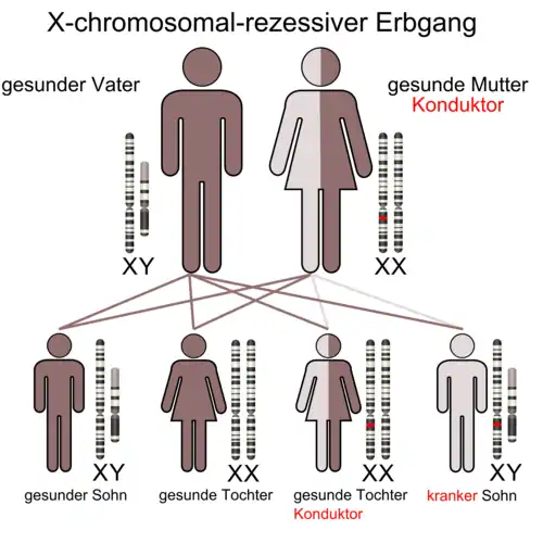 X-chromosomal durch die Mutter vererbtes, rezessives Merkmal. 50 % der Söhne tragen das Merkmal, 50 % der Töchter geben es weiter, ohne selbst betroffen zu sein.