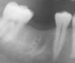Die Knochenfächer (Alveolen) des ersten unteren Mahlzahnes sind auch nach Monaten noch nicht wieder vollständig verknöchert.